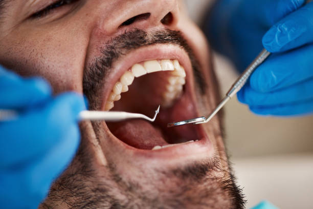 Best Emergency Root Canal Treatment in Mount Vernon, MD