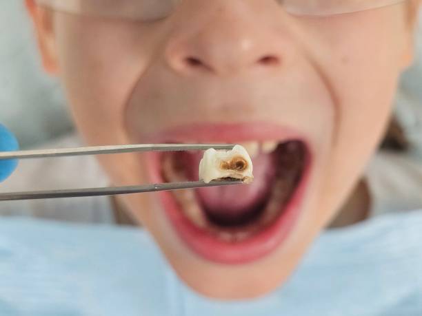 Best Emergency Wisdom Teeth Removal in Mount Vernon, MD